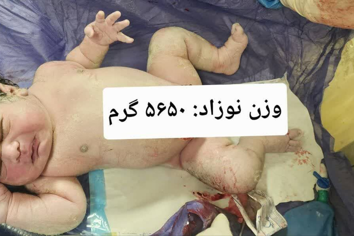تولد نوزاد ۵ کیلو و ۶۵۰ گرمی در بیمارستان امام رضا(ع) کرمانشاه